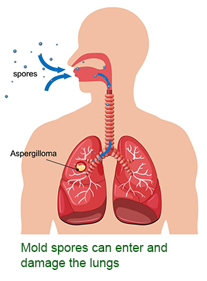 Mold spores can enter and damage the lungs